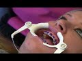 Just Orthodontics – How we put Damon Q braces on your teeth