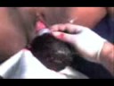 Natural Final Vaginal Stage Labor Childbirth - Episiotomy-B