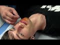 staph infection removed from my face (part 1 of 2)