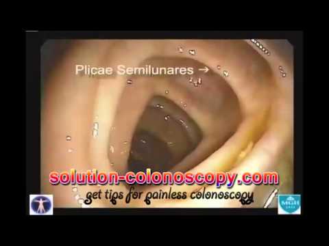 how to perform colonoscopy
