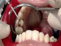 Ultradent Unicore Post
