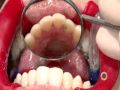 Ultradent Unicore Post