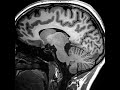 3D MPRAGE MRI scan acquired with a 32 channel head coil on a 3 Tesla Siemens Trio scanner at MGH in Boston.