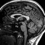 MRI of Brain