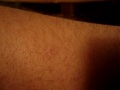 possible brown recluse bite. possible brown recluse bite.