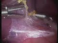 Laparoscopic Splenectomy Laparoscopic Splenectomy
