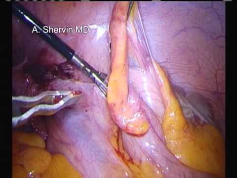 how to treat iud cramps