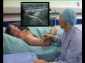 Radial Nerve Block (ultrsound guided)