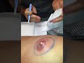 Keegan's Pus Exploding Nipple
