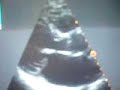 Prolapso de valva posterior mitral