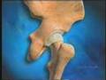 EYE ON HEALTH - OSTEOARTHRITIS Information