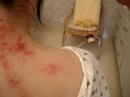 acupuncture needle moxa acupuncture needle moxa