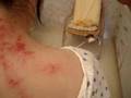 acupuncture needle moxa