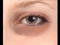Dark Circles, Bags and puff eyes