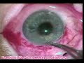 Planned extracapsular cataract extraction Planned extracapsular cataract extraction