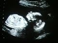 Ultrasound Week 15 Video