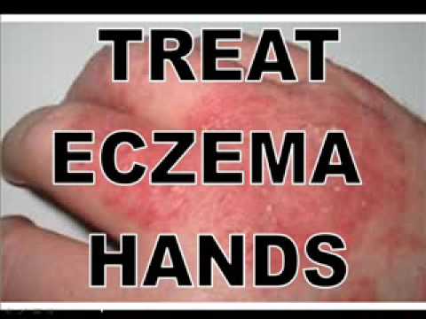 how to treat eczema on hands