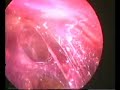 total extraperitoneal repair of hernia total extraperitoneal repair of hernia