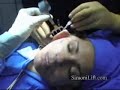 Face lift of The future: Simoni Lift