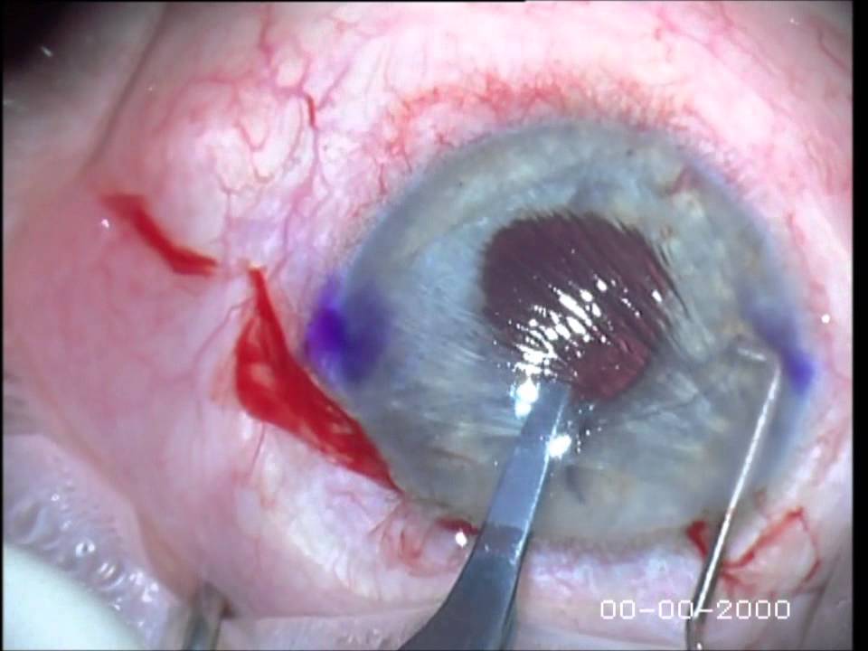 Implante secundario de lente intraocular de anclaje en iris (ARTISAN)