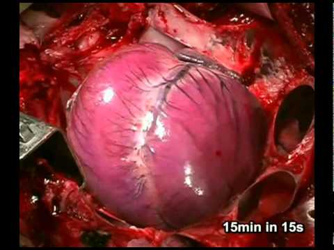 how to treat ventricular fibrillation