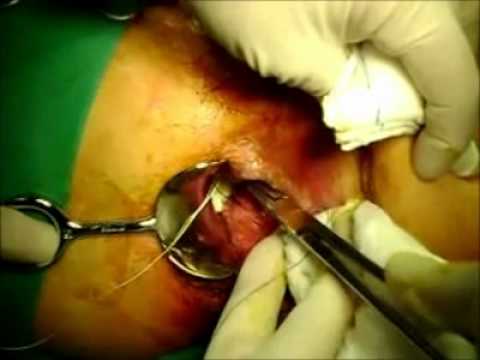 VIDEOS OPERACION videos operacion: