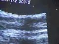 Bloqueo ilioinguinal por Ecografia