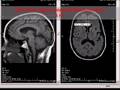videos de 2007 Brain MRI Signal Intensity Measurements