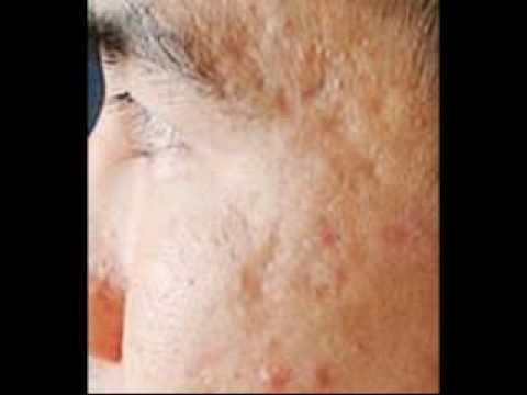 how to be acne free in 3 days