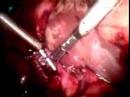 Catheter-Stone-Out