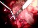 Catheter-Stone-Out