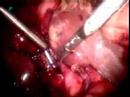 Catheter-Stone-Out