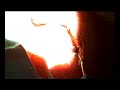 Cataract Eye Surgery Cataract Eye Surgery