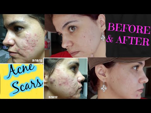 How to get rid of ACNE SCARS- (microdermabrasion)
