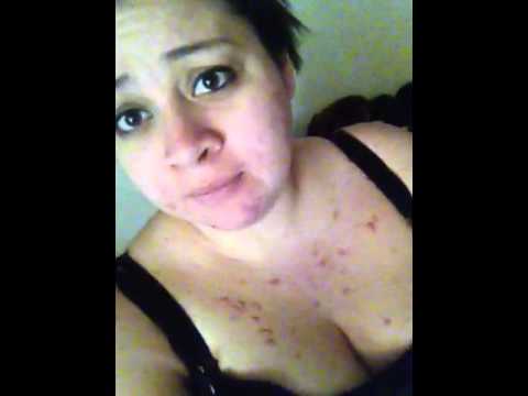how to apply erytop gel