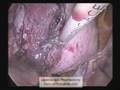 Laparoscopic Myomectomy with Harmonic Scalpel