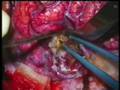 Brain AVM 18 year female