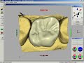 CEREC Crown Software