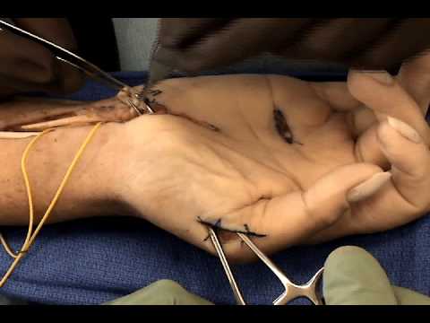 how to repair nerve damage