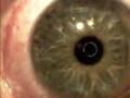 LASIK Surgery