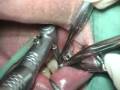 Dental  Implant Complication (2)