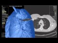 3D lung cancer