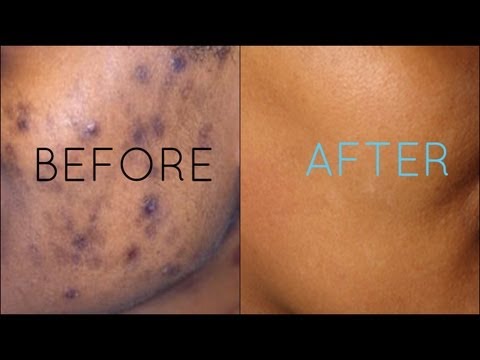 Dark Spots Fade Away | Remove Dark Spots Extract White Heads