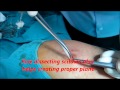 Complete Sebaceous Cyst Left Arm Removal Surgery