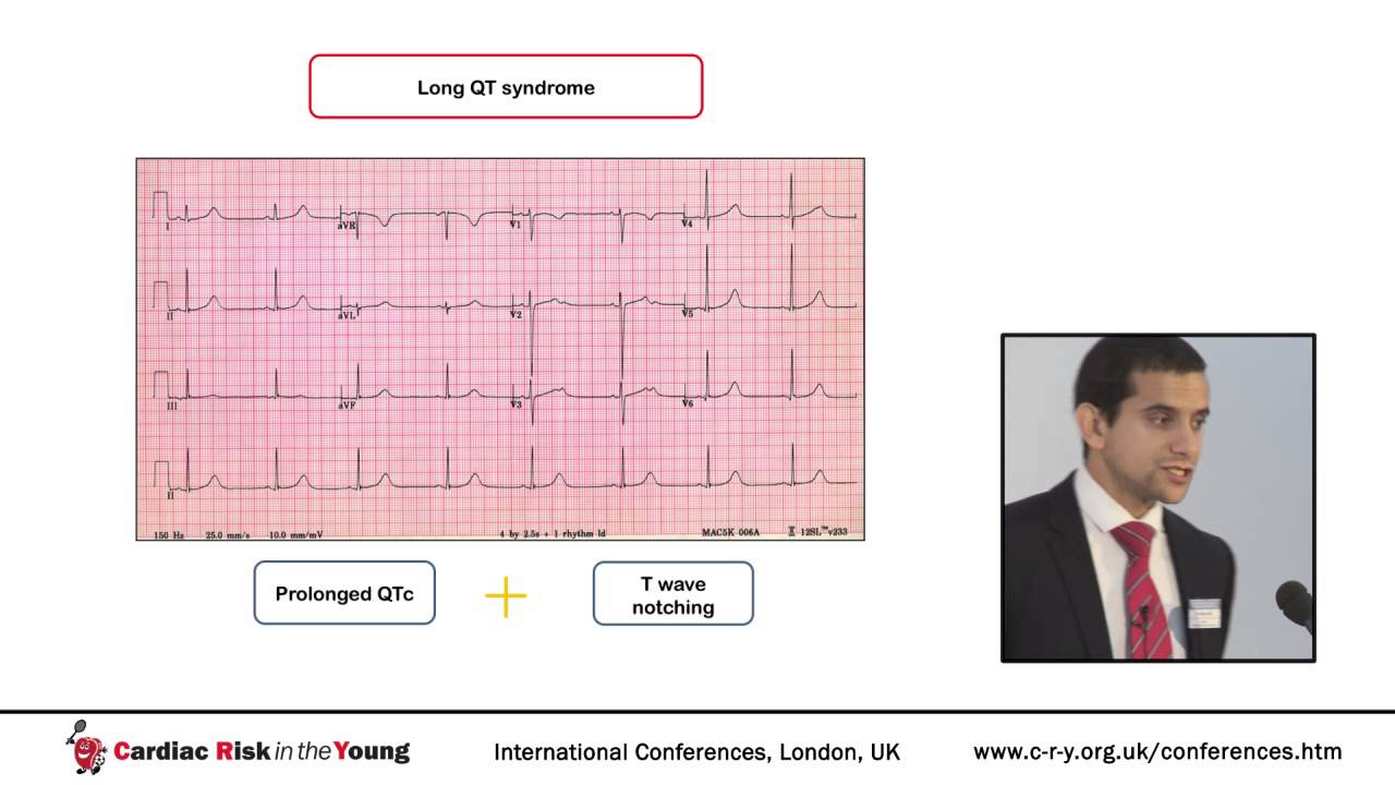 Cardiac Evaluation of Athletes