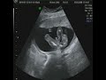bebe 18 semanas emabarazo comentado por el ginec�logo