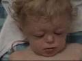 Craniosynostosis before and after surgery!!