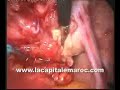 laparoscopic-managem