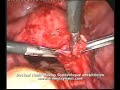 laparoscopic-managem