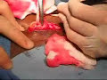 inguinal lenf nod biyopsisi